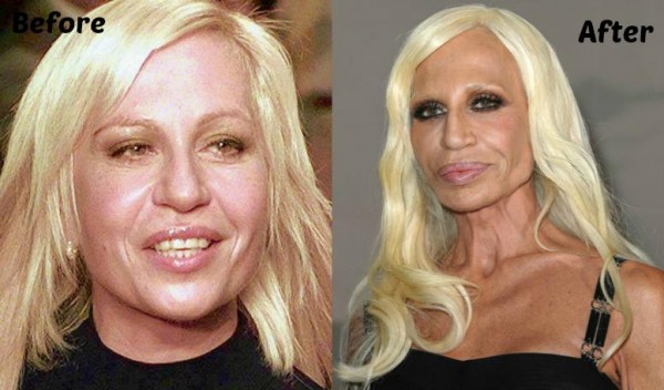 1Donatella-Versace-Plastic-Surgery3