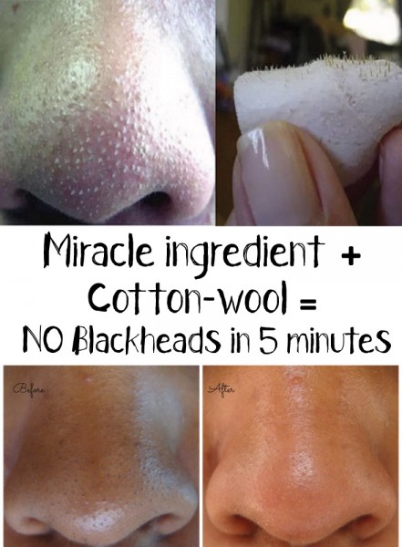 Miracle-method-to-get-rid-of-blackheads